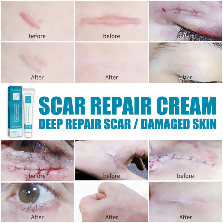 Scar Repair Cream Desalinates Old Scald Burns - BEAUTIRON
