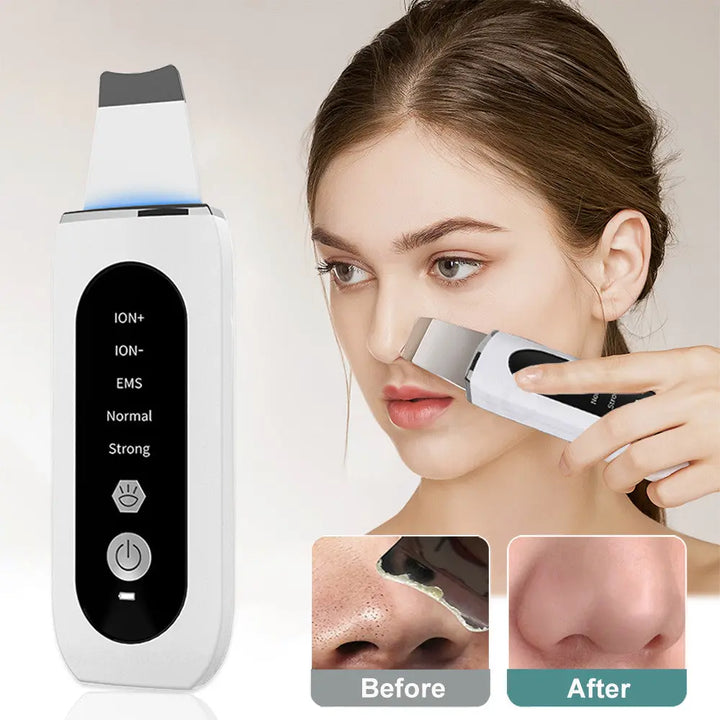 Shovel Skin Blackhead Ultrasonic Beauty Microcurrent - BEAUTIRON