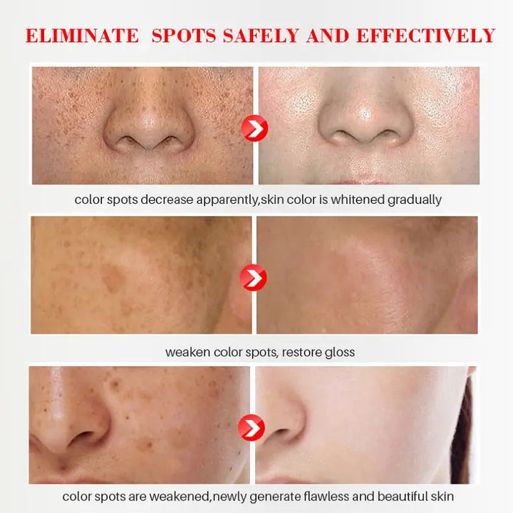 Whitening And Freckle Cream To Reduce Spots And Moisturizing - Zera