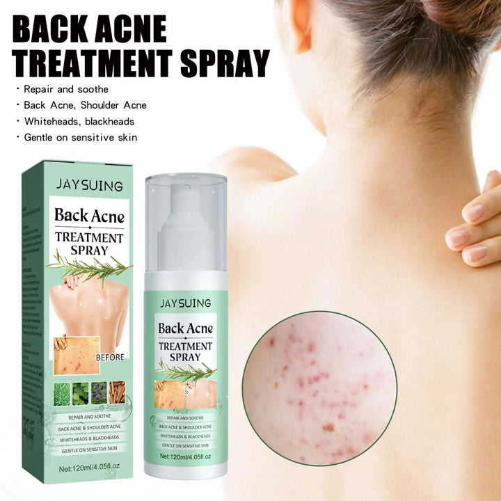 Back Acne Repair Back Shoulder Acne Desalination Acne Mark Skin Care Spray - BEAUTIRON