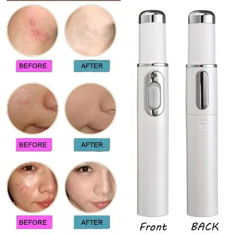 Portable and Convenient Acne Solution