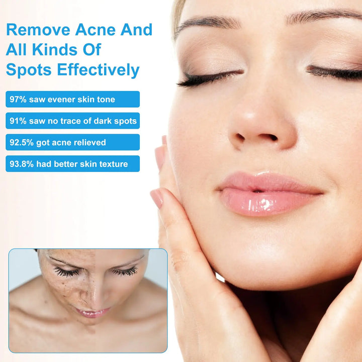 Desalting Pimple Spot Emulsion Reduces Closed Mouth Zera