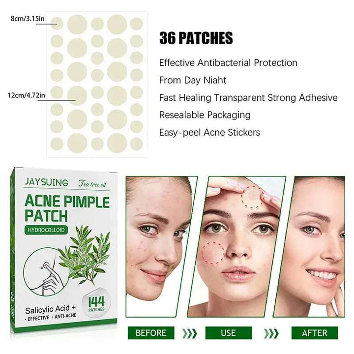 144 Patches Acne Pimple Patch Face Invisible Stickers Quick Effect Treatment Removing Patches Beauty Acne Tools Face Skin Care - BEAUTIRON