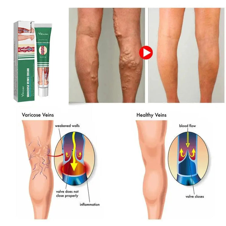 Varicose Vein Treatments Cream Effective Relieve Legs Dilated Vasculitis Phlebitis Natural Formula Ointment For Varicose Veins - BEAUTIRON