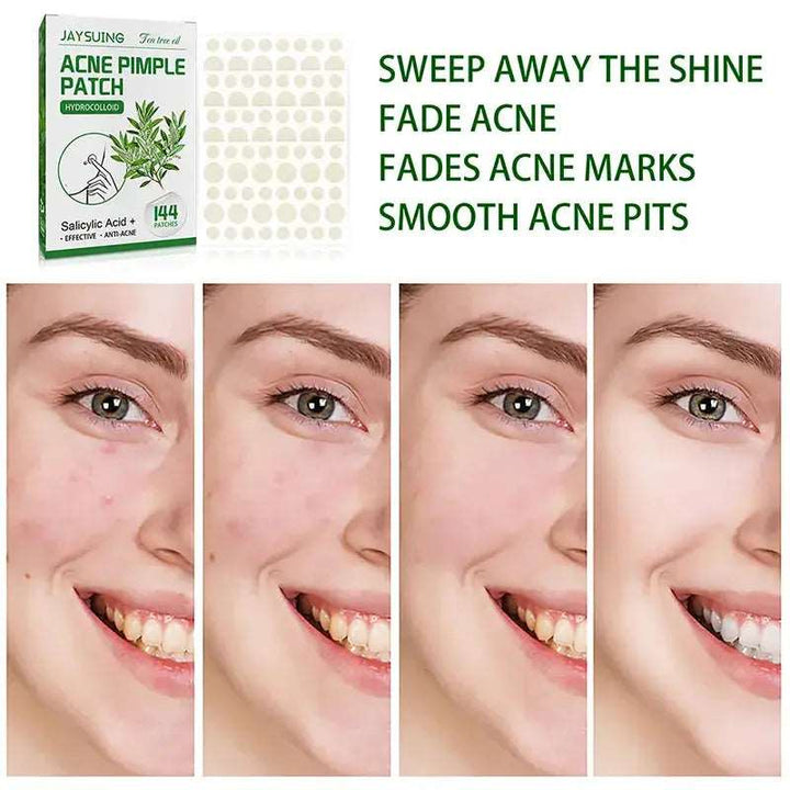 144 Patches Acne Pimple Patch Face Invisible Stickers Quick Effect Treatment Removing Patches Beauty Acne Tools Face Skin Care - BEAUTIRON