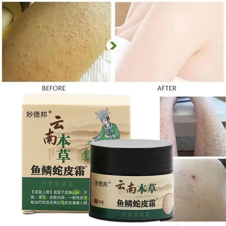 New Chicken Skin Repair Cream Curing Keratosis Follicle Pilaris Remove Thick Pores Body Dark Spot Moisturize Smooth Skin Care - BEAUTIRON