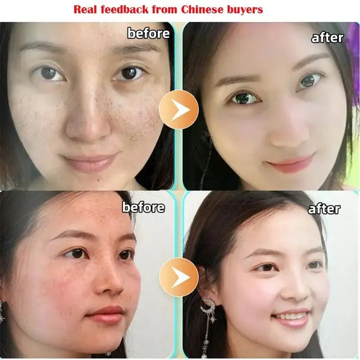 Dark Spot Corrector Skin Whitening Fade Cream Lighten Blemish Removal Serum Reduces Freckles Melasma Sun Spot Brighten Skin Care - BEAUTIRON