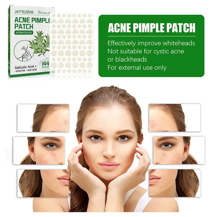 144 Patches Acne Pimple Patch Face Invisible Stickers Quick Effect Treatment Removing Patches Beauty Acne Tools Face Skin Care - BEAUTIRON