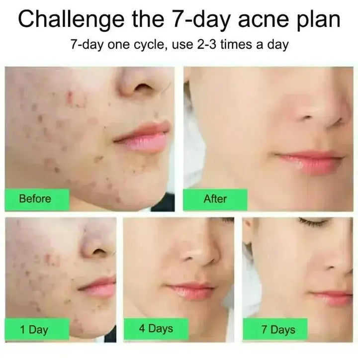 Salicylic Acid Acne Treatment Cream Shrinking Anti-acne Oil Deep Cleaning Pore Repair Pimple Spots Control Moisturizer Skin Care - BEAUTIRON