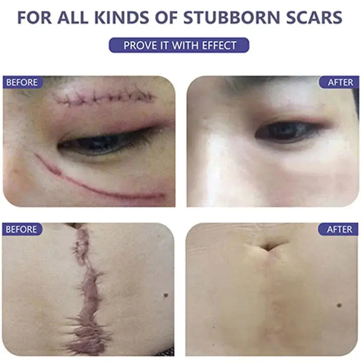 100% Silicone Scar Removal Cream Gel Burn Surgical Scar Cesarean Scar Repairing Stretch Marks Whitening Pigmentation Corrector - BEAUTIRON