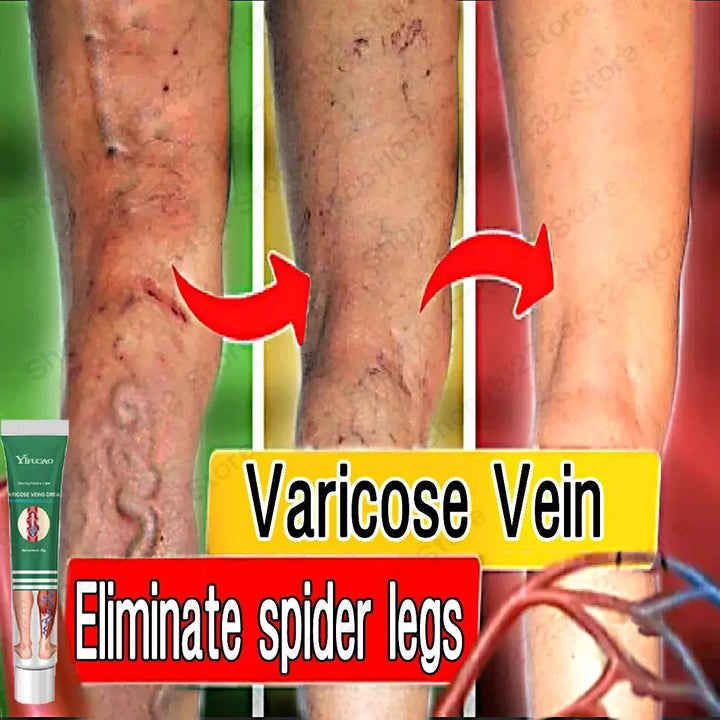 Varicose Vein Treatments Cream Effective Relieve Legs Dilated Vasculitis Phlebitis Natural Formula Ointment For Varicose Veins - BEAUTIRON