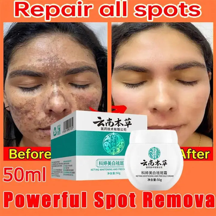 Dark Spot Corrector Skin Whitening Fade Cream Lighten Blemish Removal Serum Reduces Freckles Melasma Sun Spot Brighten Skin Care - BEAUTIRON