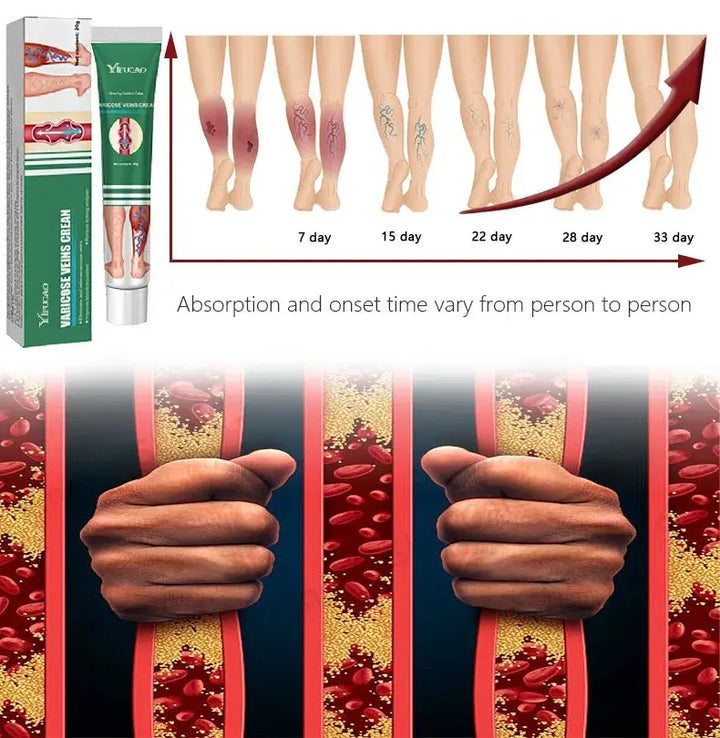 Varicose Vein Treatments Cream Effective Relieve Legs Dilated Vasculitis Phlebitis Natural Formula Ointment For Varicose Veins - BEAUTIRON