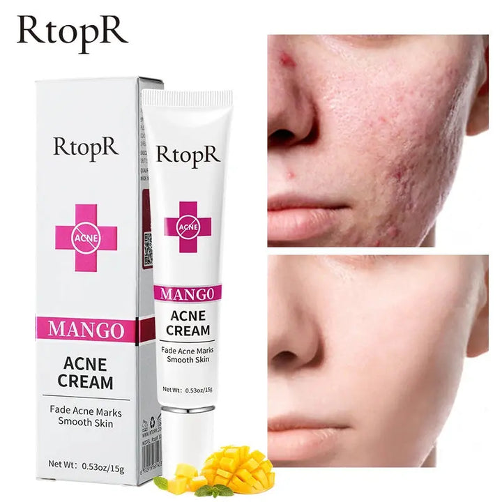 Acne Cream Acne Mark Removal Acne Mild Repair Damaged Skin Hydration Nourishment Rejuvenation Skin Brightening Skin Care - BEAUTIRON