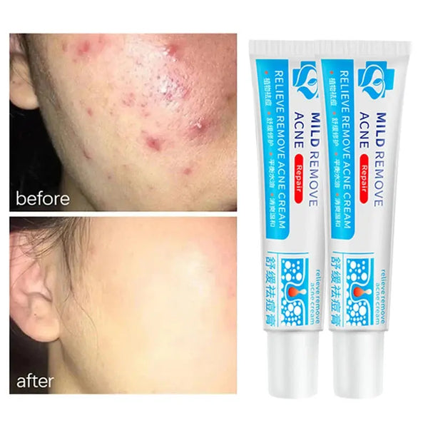 Salicylic Acid Acne Treatment Cream Shrinking Anti-acne Oil Deep Cleaning Pore Repair Pimple Spots Control Moisturizer Skin Care - BEAUTIRON