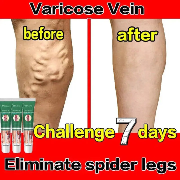 Varicose Vein Treatments Cream Effective Relieve Legs Dilated Vasculitis Phlebitis Natural Formula Ointment For Varicose Veins - BEAUTIRON