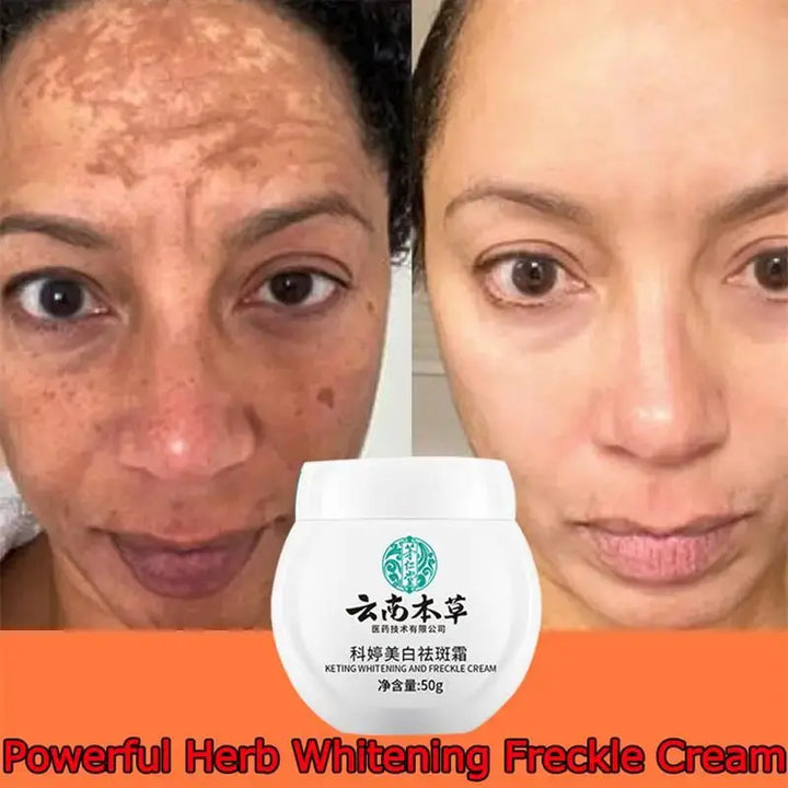 Dark Spot Corrector Skin Whitening Fade Cream Lighten Blemish Removal Serum Reduces Freckles Melasma Sun Spot Brighten Skin Care - BEAUTIRON