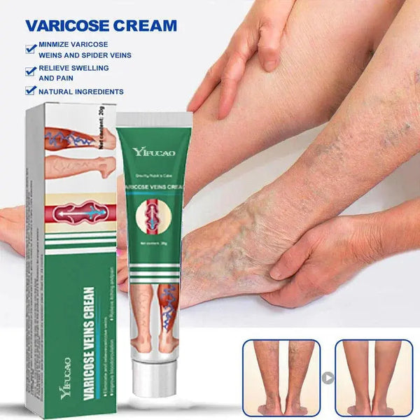 Varicose Vein Treatments Cream Effective Relieve Legs Dilated Vasculitis Phlebitis Natural Formula Ointment For Varicose Veins - BEAUTIRON
