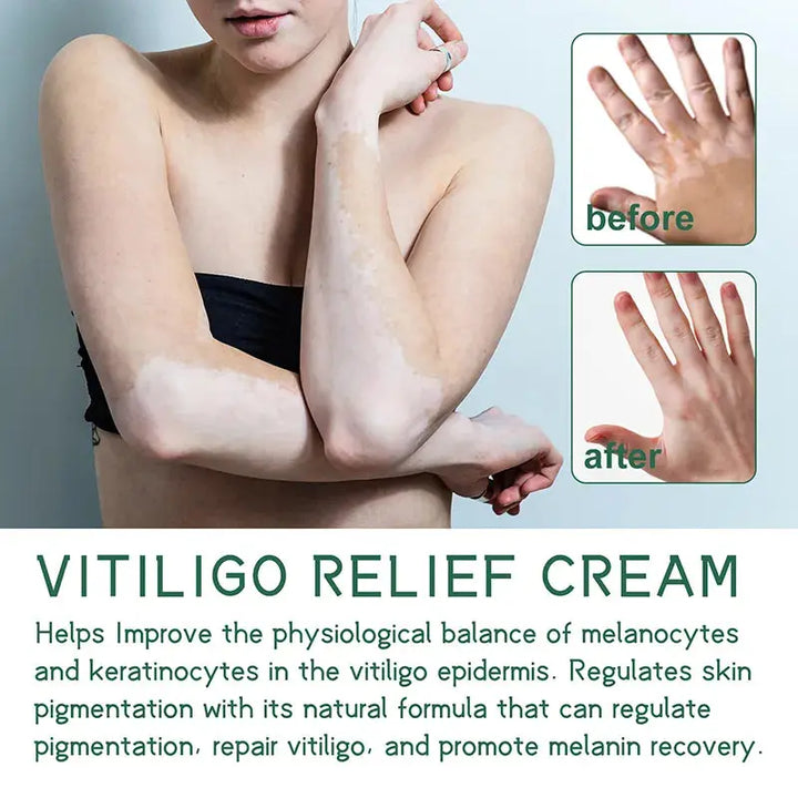 Vitiligo Ointment Remove Ringworm White Spot Gel Removal Skin Vitiligo Eliminate Vitiligo External Skin Care Ointment 2023 New - BEAUTIRON