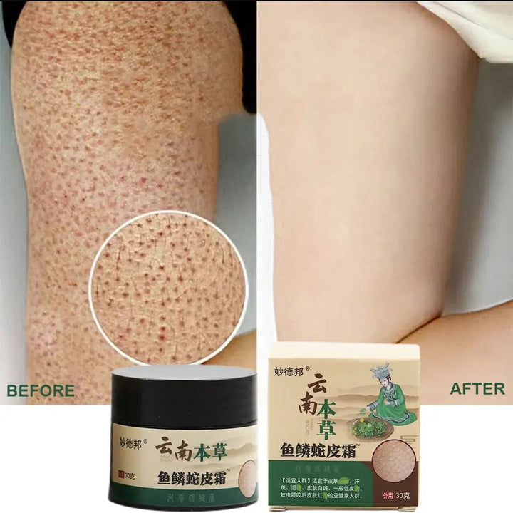 New Chicken Skin Repair Cream Curing Keratosis Follicle Pilaris Remove Thick Pores Body Dark Spot Moisturize Smooth Skin Care - BEAUTIRON