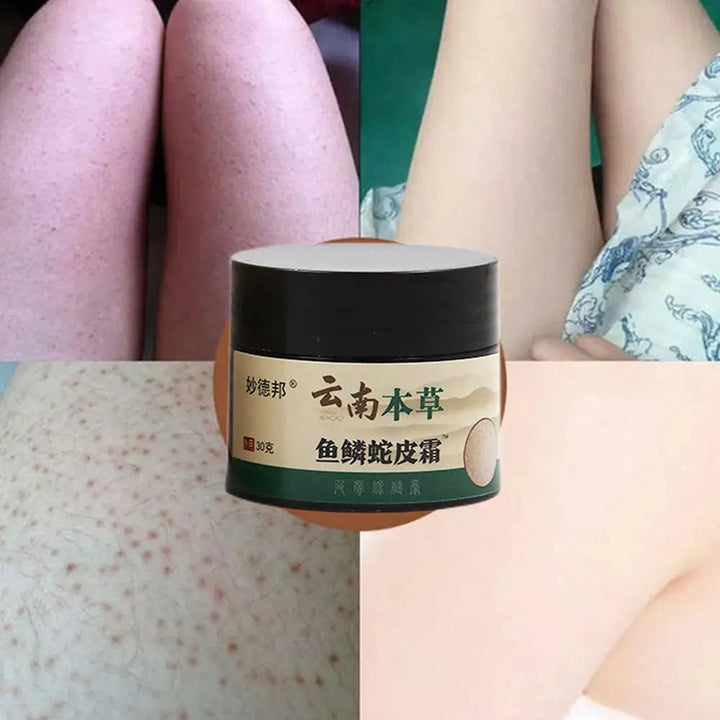 New Chicken Skin Repair Cream Curing Keratosis Follicle Pilaris Remove Thick Pores Body Dark Spot Moisturize Smooth Skin Care - BEAUTIRON