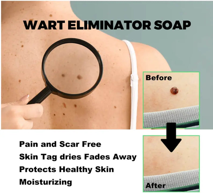 Mole Removal G Wart Grain Filamentous Wart Body Cleaning Soap - BEAUTIRON