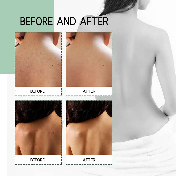 Back Acne Repair Back Shoulder Acne Desalination Acne Mark Skin Care Spray - BEAUTIRON