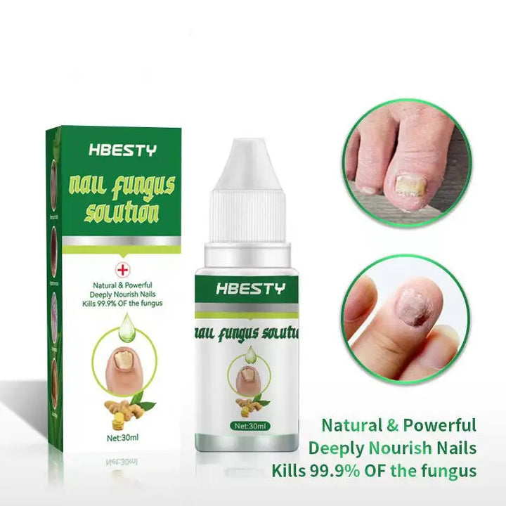 Nail Fungal Treatment Feet Care Nail Foot Toe Nail Fungus Removal Gel Anti Infection Paronychia Onychomycosis - BEAUTIRON