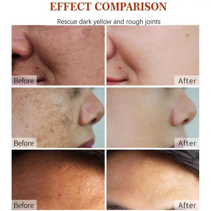 Korean Natural Vegan Neck Facial Vitamin C Acne Pimples Dark Spot Remover - Zera