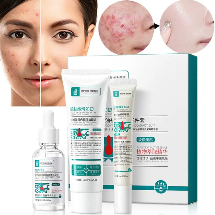 Herbal Acne Removal Face Cream - Zera