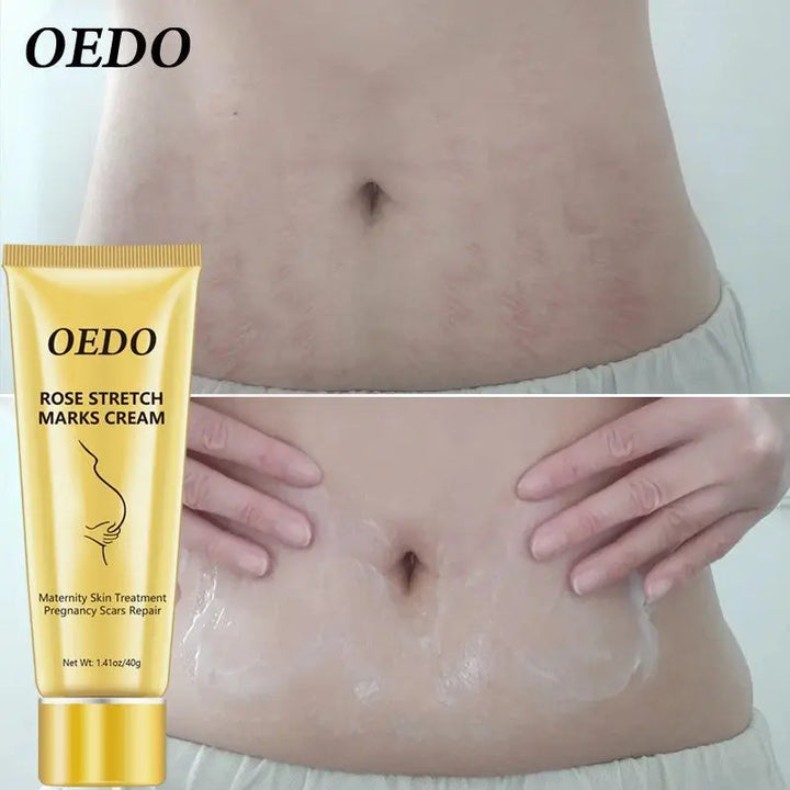 a woman's stomach with a tube of oedo on it